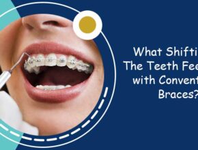 What Shifting of The Teeth Feels Like with Conventional Braces